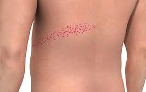 Shingles - the painful reminder of chickenpox